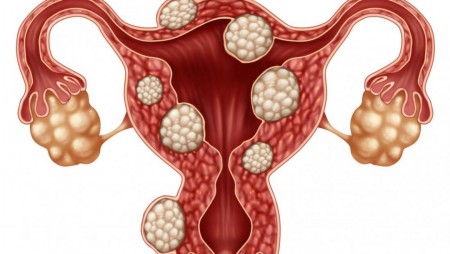 PHƯƠNG PHÁP ĐÁNH BAY U XƠ TỬ CUNG HIỆU QUẢ