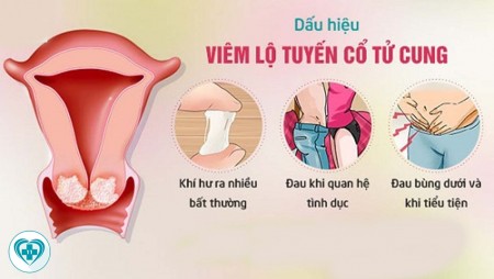 Cách chữa bệnh viêm lộ tuyến cổ tử cung