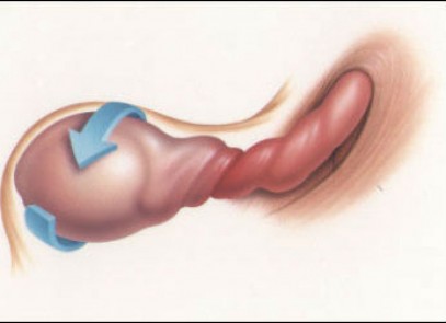 CHỮA BỆNH XOẮN TINH HOÀN NHƯ THẾ NÀO HIỆU QUẢ?