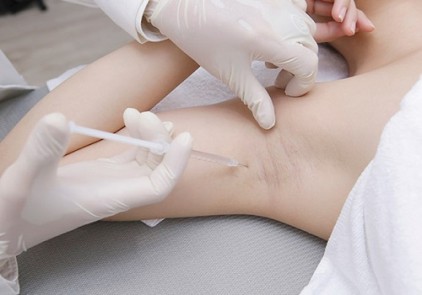 NỘI SOI HÔI NÁCH – PHƯƠNG PHÁP MANG LẠI HIỆU QUẢ CHO NHIỀU BỆNH NHÂN