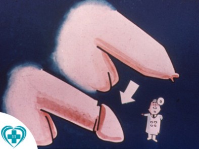 CẮT BAO QUY ĐẦU LÀ GÌ?