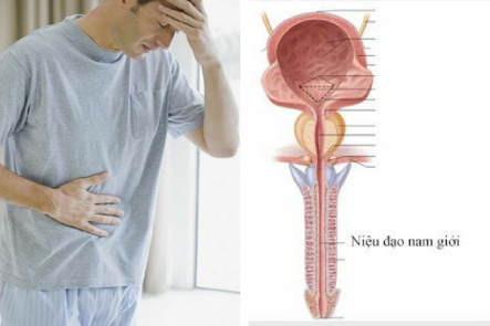 BẮT BỆNH VIÊM ĐƯỜNG TIẾT NIỆU