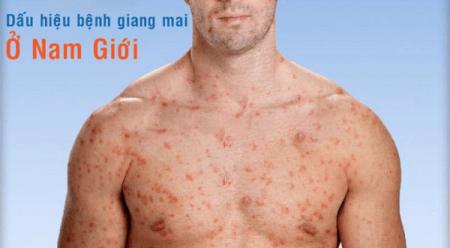 NHẬN BIẾT BỆNH GIANG MAI THÔNG QUA TRIỆU CHỨNG